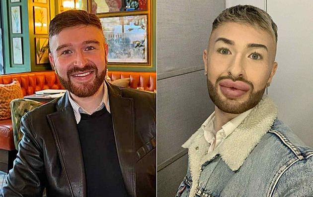 Propadl závislosti na botoxu, měl ho všude. Dnes se muž vrací k původnímu já