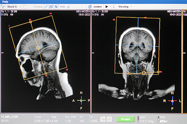 Pražané mají zájem o preventivní vyšetření v „tunelu“, bez žádanky to ale nejde