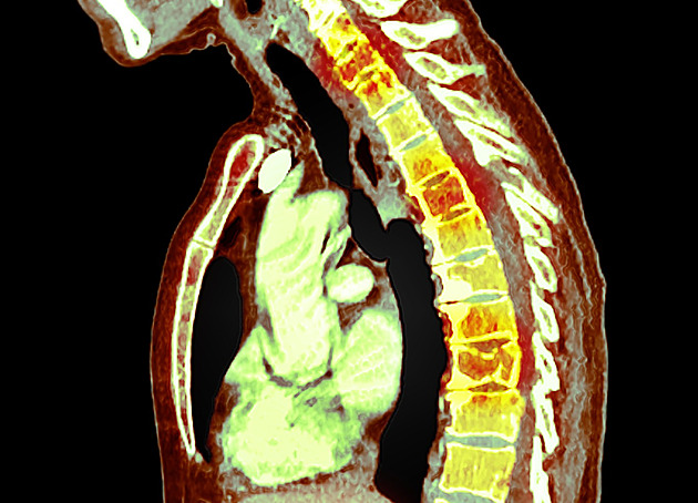 Zlomená žebra, únava a šokující diagnóza. Marie bojuje s mnohočetným myelomem